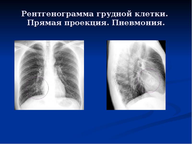 Рентгенограмма грудной клетки.  Прямая проекция. Пневмония.