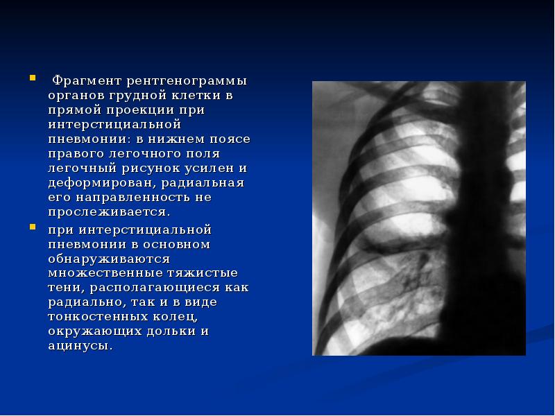 Легочной рисунок усилен деформирован