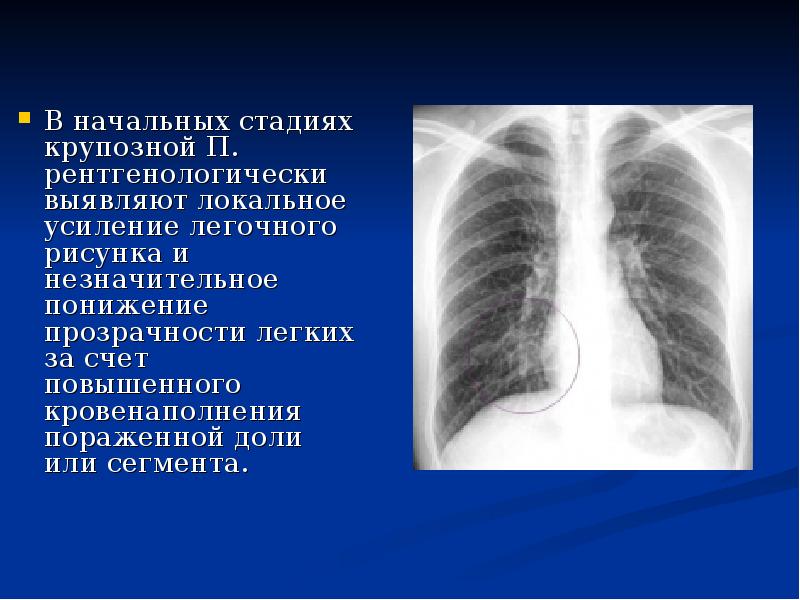 Легочный рисунок в базальных отделах. Пневмония стадия опеченения рентген. Крупозная пневмония рентгенограмма грудной клетки. Крупозная пневмония стадия разрешения рентген. Пневмония в стадии разрешения рентген.