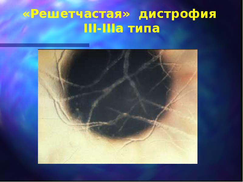 Дистрофия базальной мембраны эпителия. Дистрофия мозга что это. Окулофарингеальная миопатия. Окулофарингеальная мышечная дистрофия. Дистрофия мозга что это.