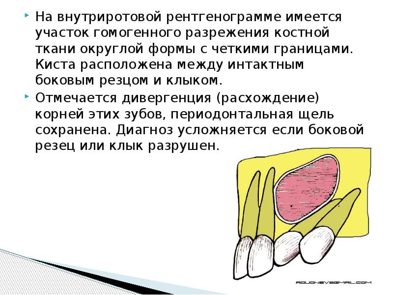 Неодонтогенные кисты презентация