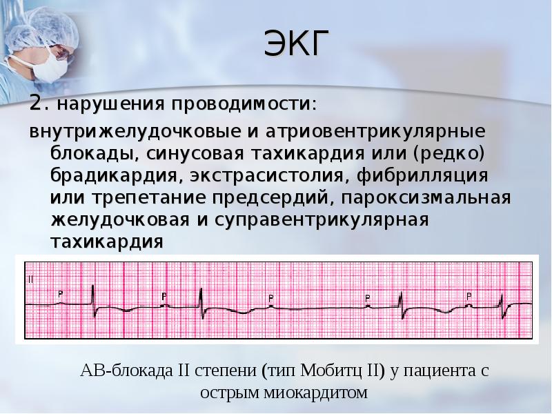 Экг нарушение внутрижелудочковой. Нарушения желудочковой проводимости на ЭКГ. ЭКГ при нарушении желудочковой проводимости. ЭКГ признаки нарушения внутрижелудочковой проводимости. Нарушение внутрижелудочковой проводимости на ЭКГ.