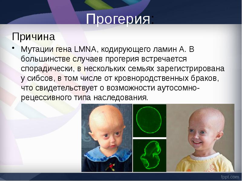 Наследственные заболевания связанные с мутациями. Наследственные заболевания прогерия. Прогерия детей – синдром Хатчинсона-Гилфорда. Генетическое заболевание прогерия. Причины болезни прогерии.