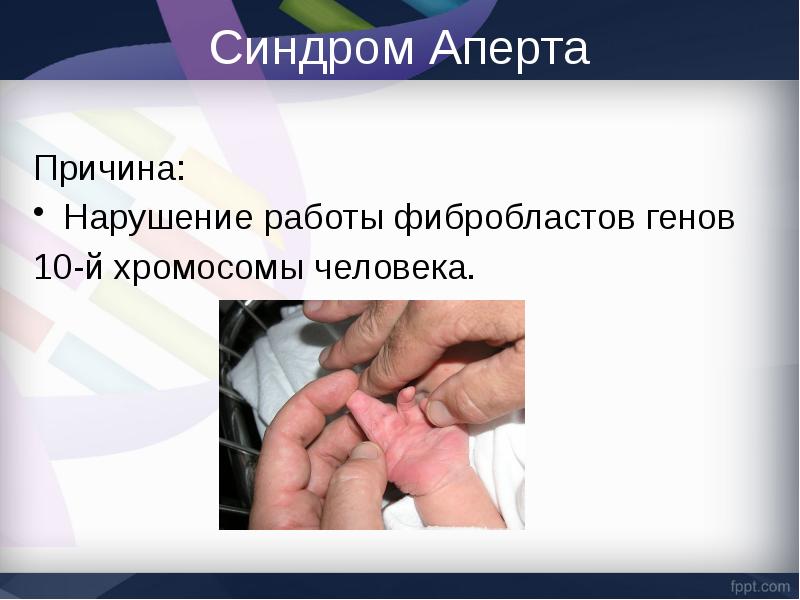 Синдром апера презентация