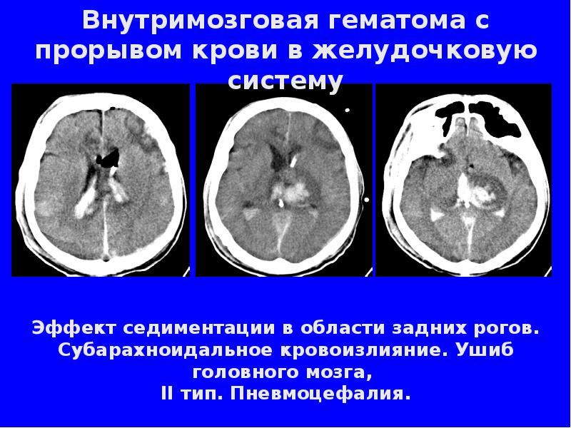 Инсульт кровоизлияние в желудочки