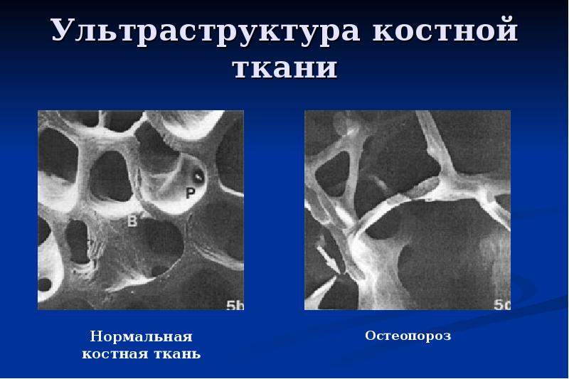 Для рентгенологической картины фолликулярной кисты характерна деструкция костной ткани в виде