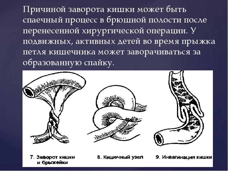 Кишечная непроходимость у детей презентация