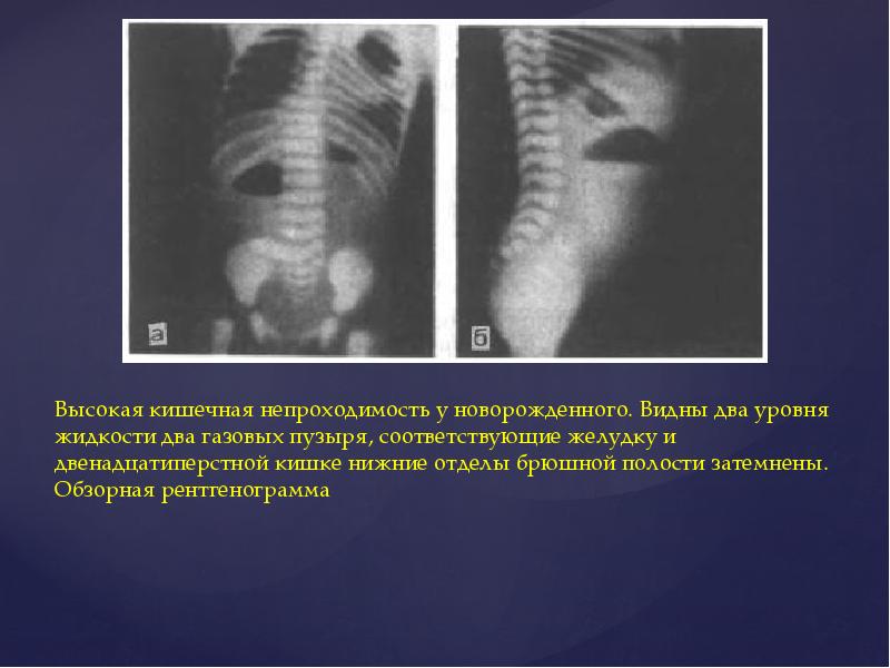 Врожденная низкая кишечная непроходимость презентация