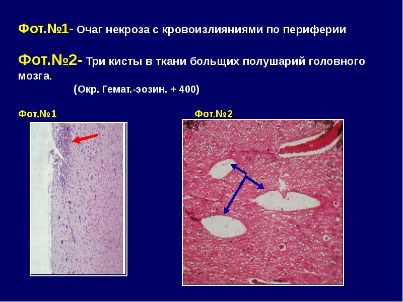 Очаг омертвления в тканях при спазме. Очаг омертвления в тканях при спазме. Невринома микропрепарат. Грануляционная ткань патогенез. Инфаркт миокарда это очаг некроза в результате.