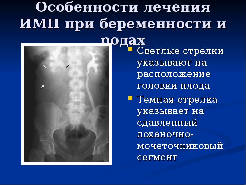 Инфекция мочевыводящих путей лечение. Лоханочно-мочеточниковый сегмент. Лоханочно-мочеточниковый сегмент расположение. Имп это в медицине.