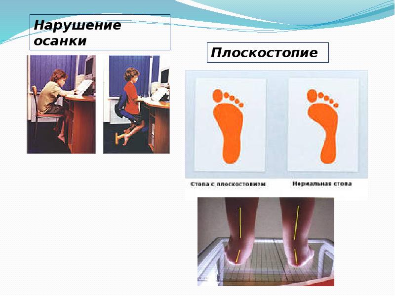 Презентация по теме плоскостопие