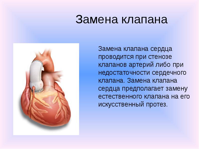 Клапан операция. Операции на клапанах сердца. Замена сердечного клапана. Операция на сердце замена клапана.