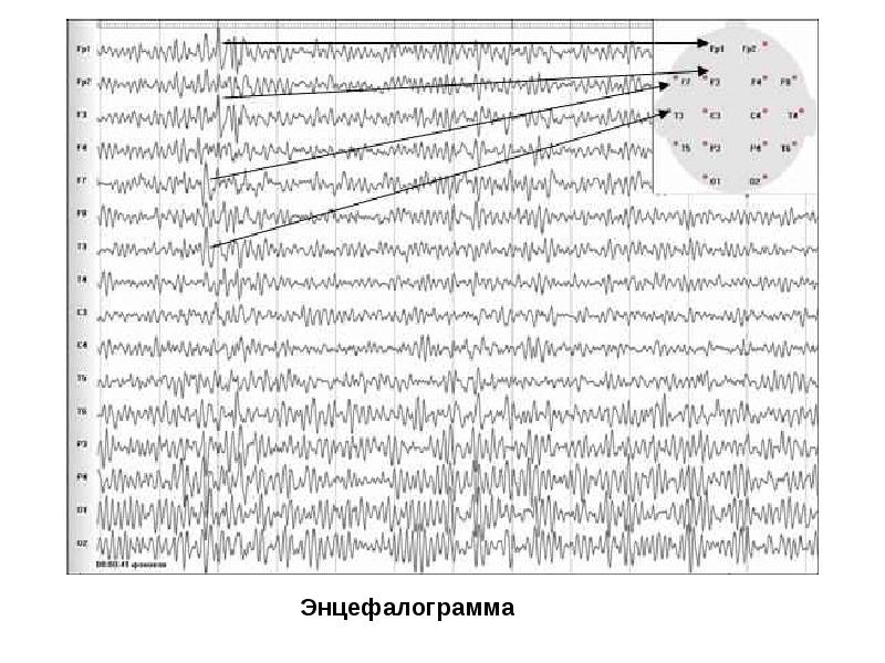 Энцефалограмма. Энцефалограмма p301. Энцефалограмма на бумаге. Энцефалограмма что показывает. Энцефалограмма хто.