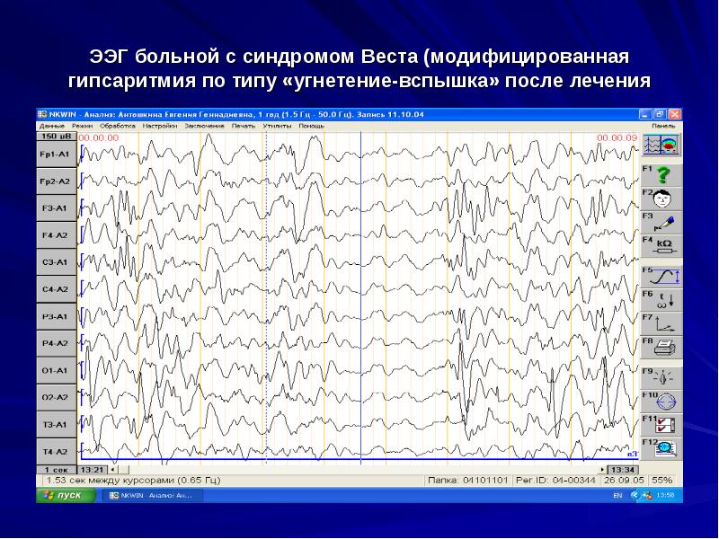 Синдром веста клинические рекомендации