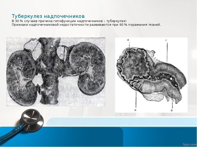 Дефицит надпочечников. Туберкулезное поражение надпочечников. Туберкулез надпочечников макропрепарат. Туберкулез почек патанатомия.