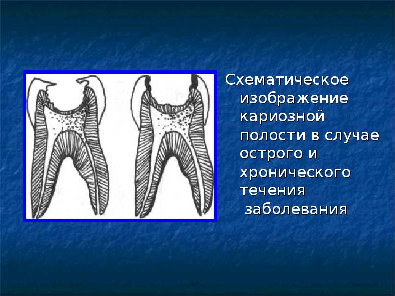 Кариозная полость сообщается с полостью зуба. Кариозная полость не сообщающаяся с полостью зуба. Пути распространения инфекции из кариозной полости.