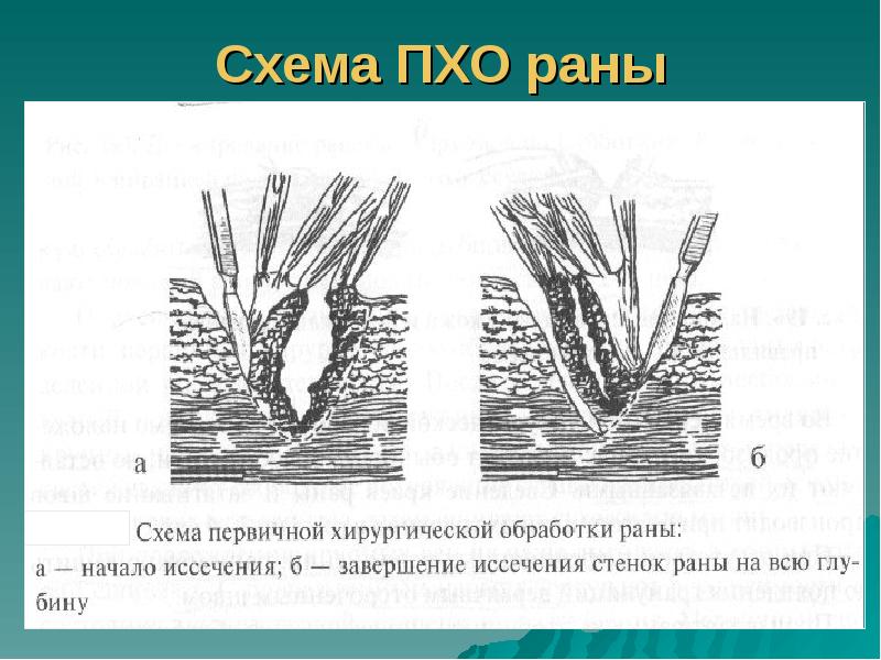 Схема ПХО раны Схема ПХО раны