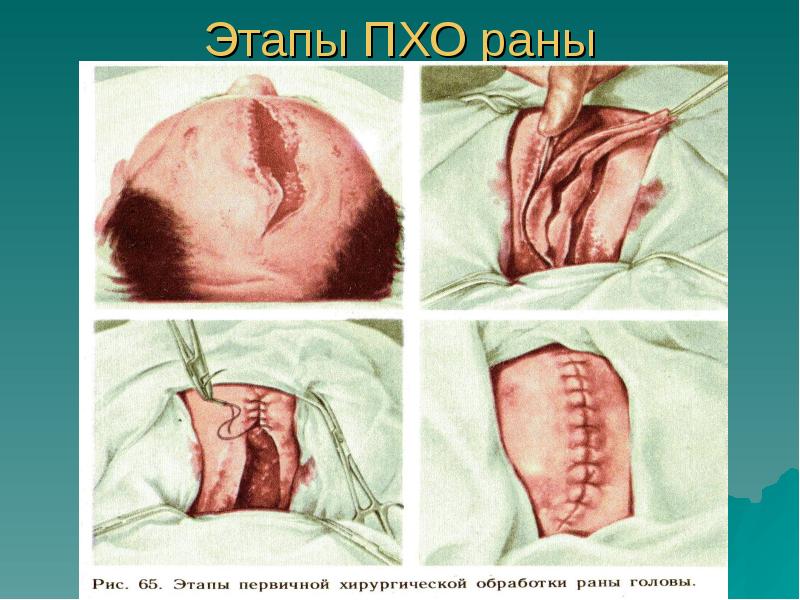 Этапы ПХО раны Этапы ПХО раны