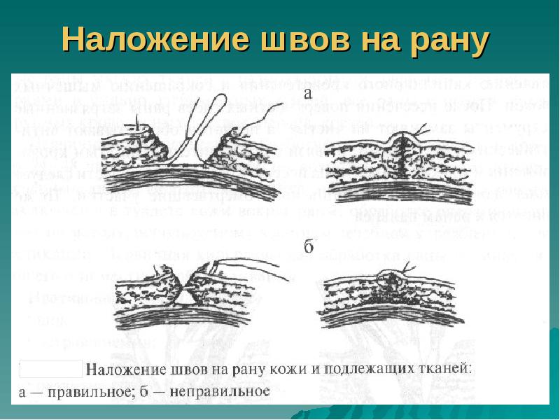 Наложение швов на рану Наложение швов на рану