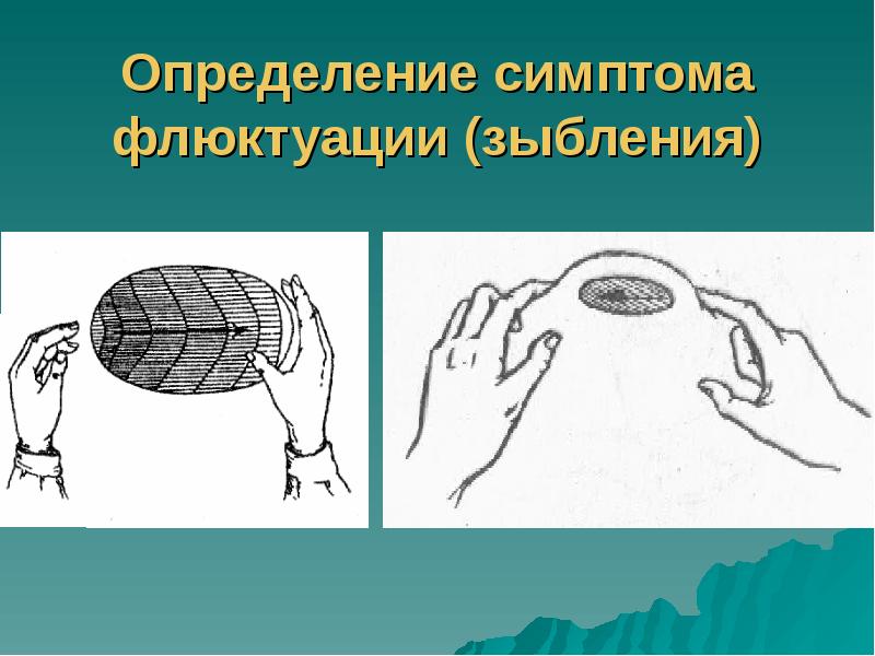 Определение симптома флюктуации (зыбления) Определение симптома флюктуации (зыбления)