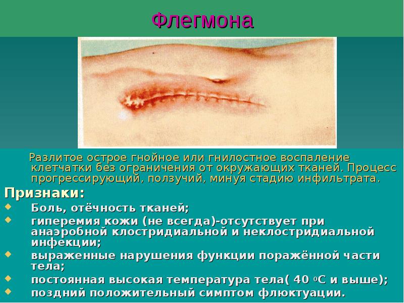 Флегмона
Разлитое острое гнойное или гнилостное воспаление Флегмона
Разлитое острое гнойное или гнилостное воспаление