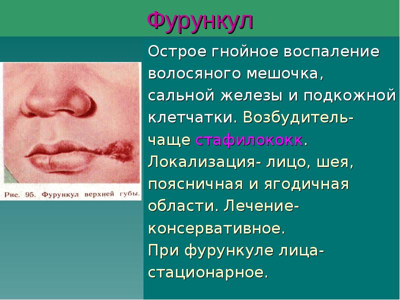 Фурункул
Острое гнойное воспаление
волосяного мешочка,
сальной железы и подкожной
клетчатки. Фурункул
Острое гнойное воспаление
волосяного мешочка,
сальной железы и подкожной
клетчатки.