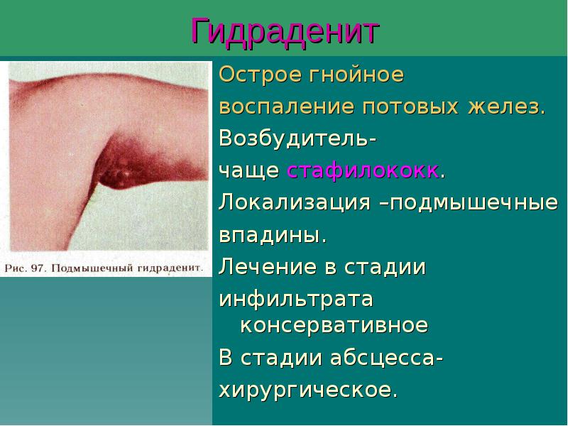 Гидраденит
Острое гнойное
воспаление потовых желез.
Возбудитель-
чаще стафилококк.
Гидраденит
Острое гнойное
воспаление потовых желез.
Возбудитель-
чаще стафилококк.