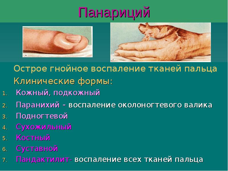 Панариций
Острое гнойное воспаление тканей пальца
Клинические Панариций
Острое гнойное воспаление тканей пальца
Клинические