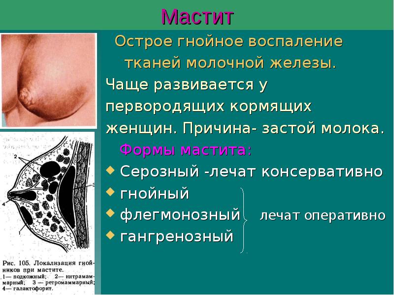 Мастит
Острое гнойное воспаление
тканей молочной железы.
Мастит
Острое гнойное воспаление
тканей молочной железы.