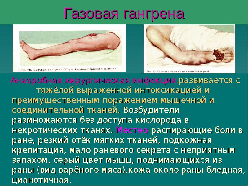Газовая гангрена
Анаэробная хирургическая инфекция развивается с Газовая гангрена
Анаэробная хирургическая инфекция развивается с