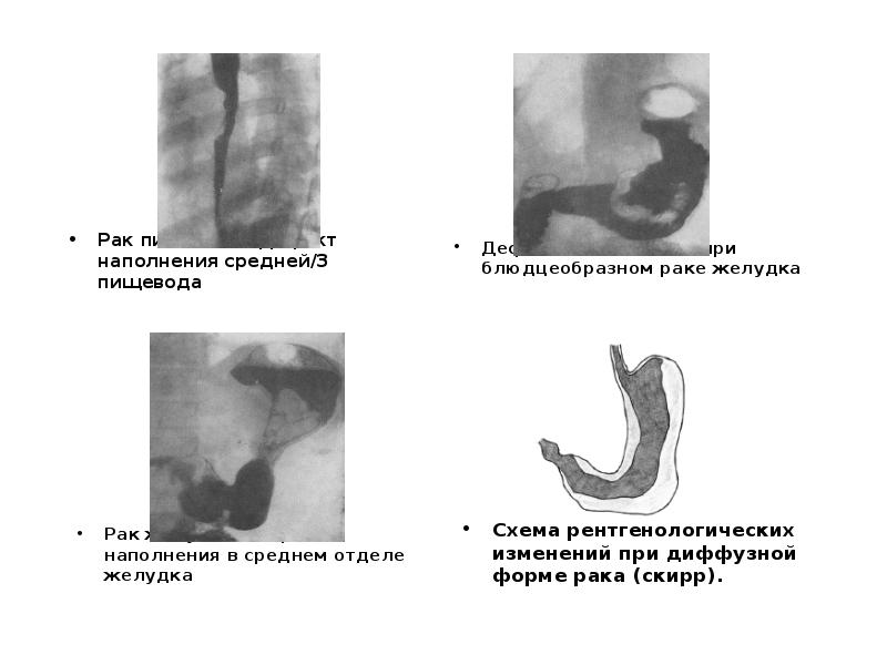 Экзофитный рак. Доброкачественная опухоль желудка схема рентген. Доброкачественные опухоли желудка схема. Доброкачественная опухоль желудка рентген. Схема доброкачественной и злокачественной опухоли желудка.