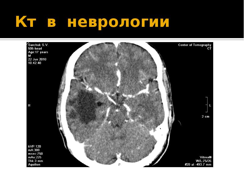 Кт в неврологии презентация