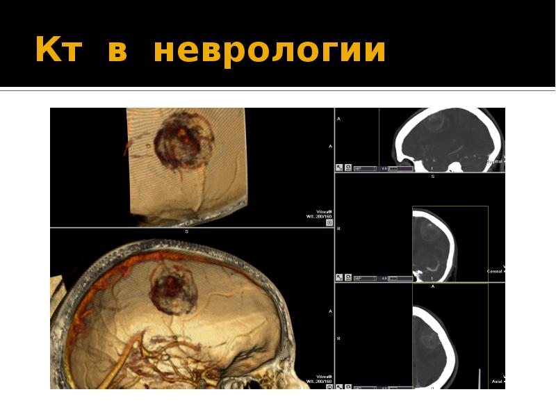 Кт в неврологии презентация