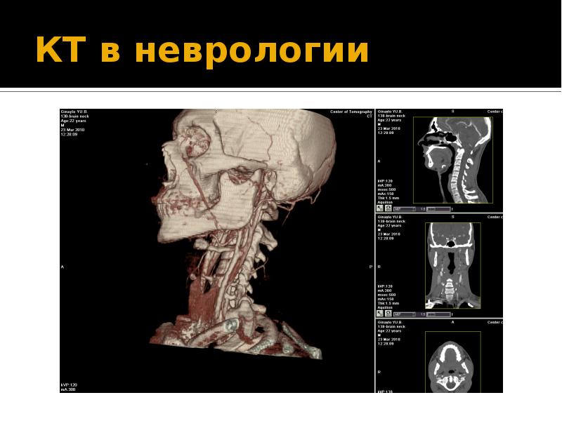 Кт в неврологии презентация