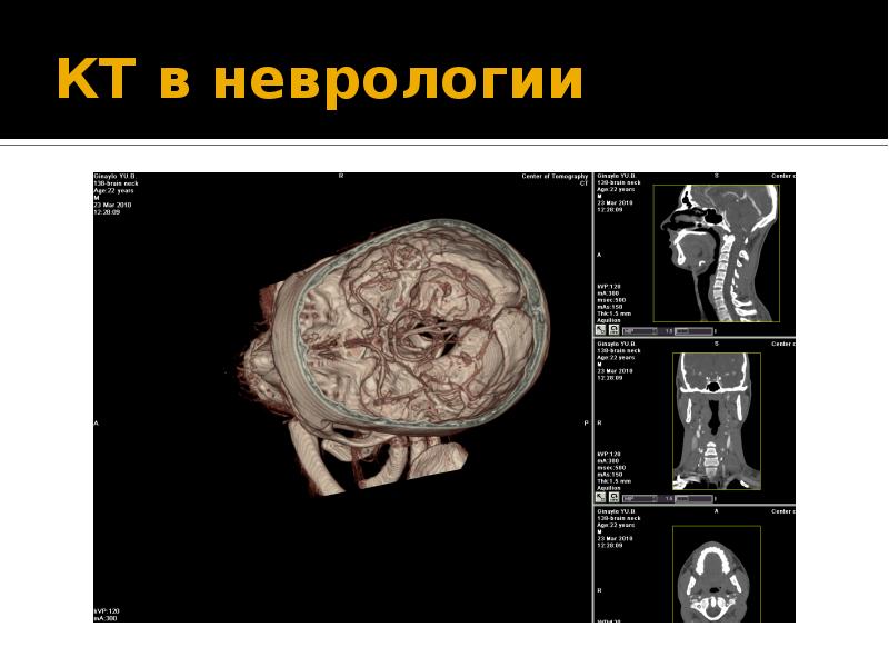 Кт в неврологии презентация