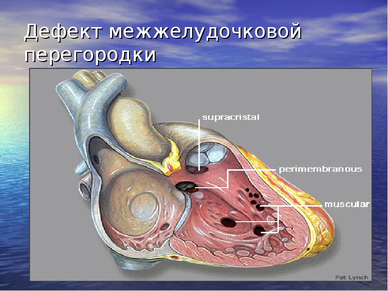 Межжелудочковая перегородка. Перимембранозный дефект межжелудочковой перегородки. ВПС дефект межжелудочковой перегородки. Инфундибулярный дефект МЖП.