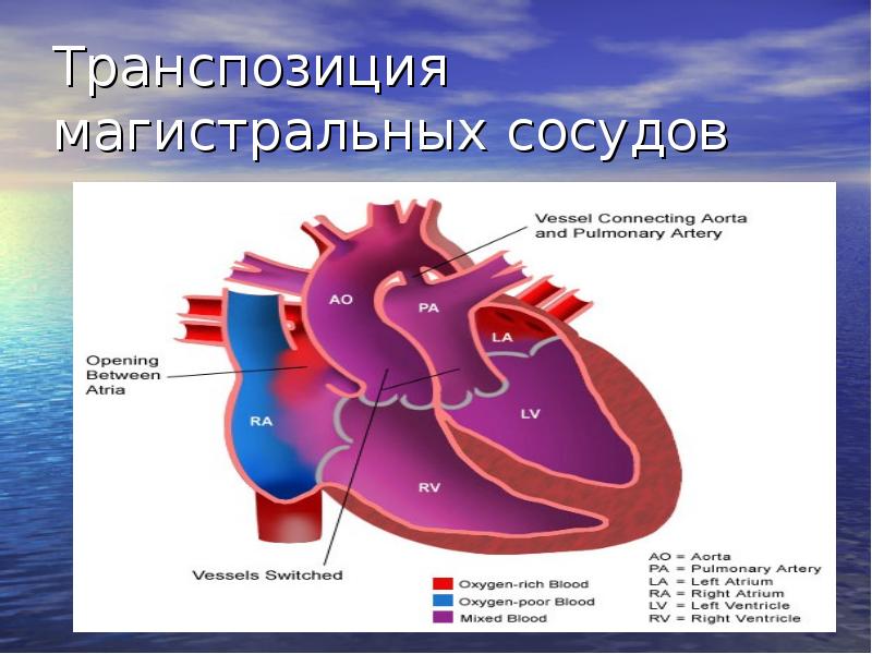 Транспозиция магистральных артерий презентация