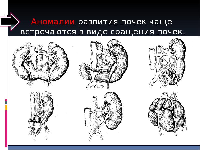 Аномалия развития почек презентация