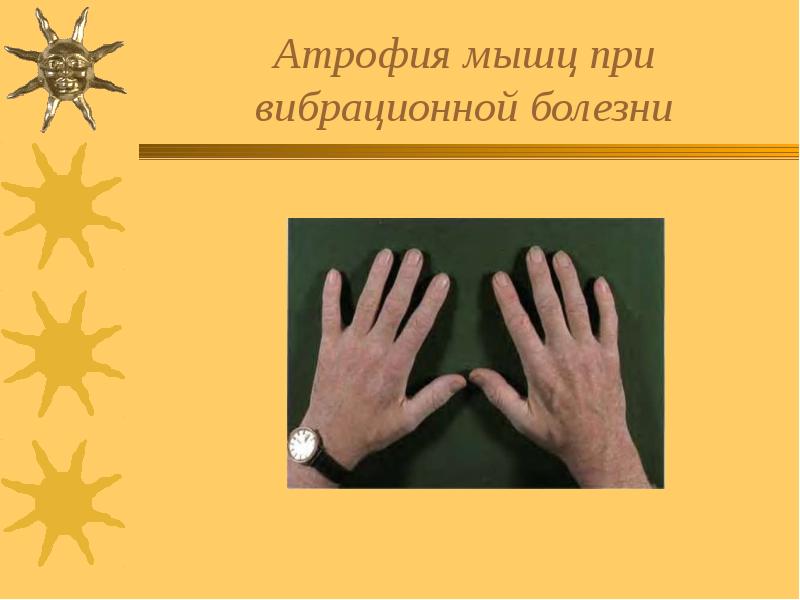 Атрофия мышц при вибрационной болезни