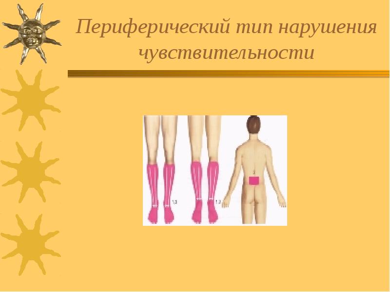 Периферический тип нарушения чувствительности
