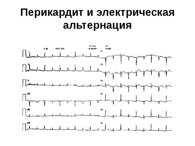 Перикардит экг картина