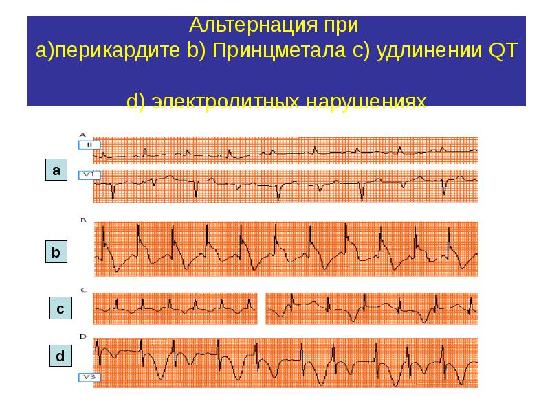 альтернация комплекса qrs