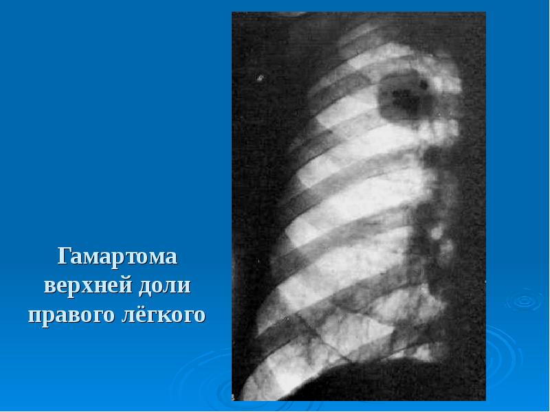 Гамартома легкого: симптомы, лечение, причины