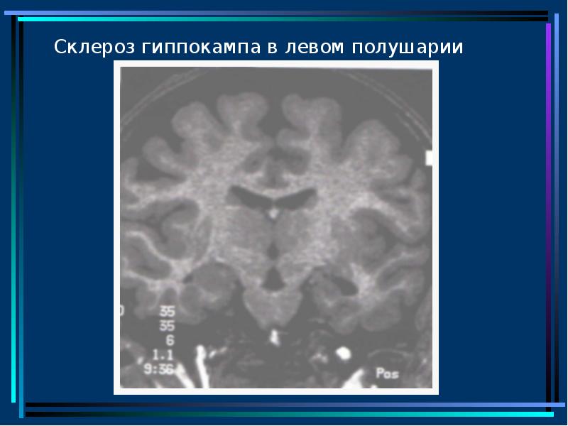 Мезиальный темпоральный склероз