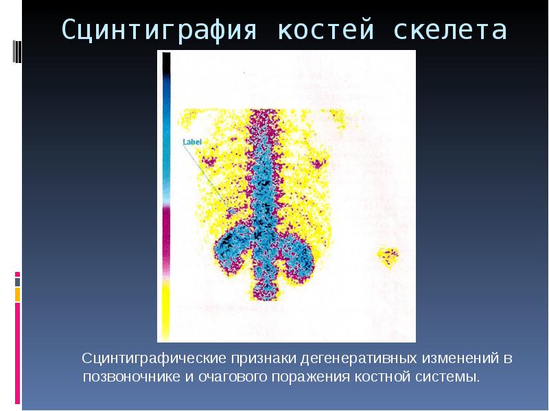 Сцинтиграфическая картина метастатического поражения костей скелета