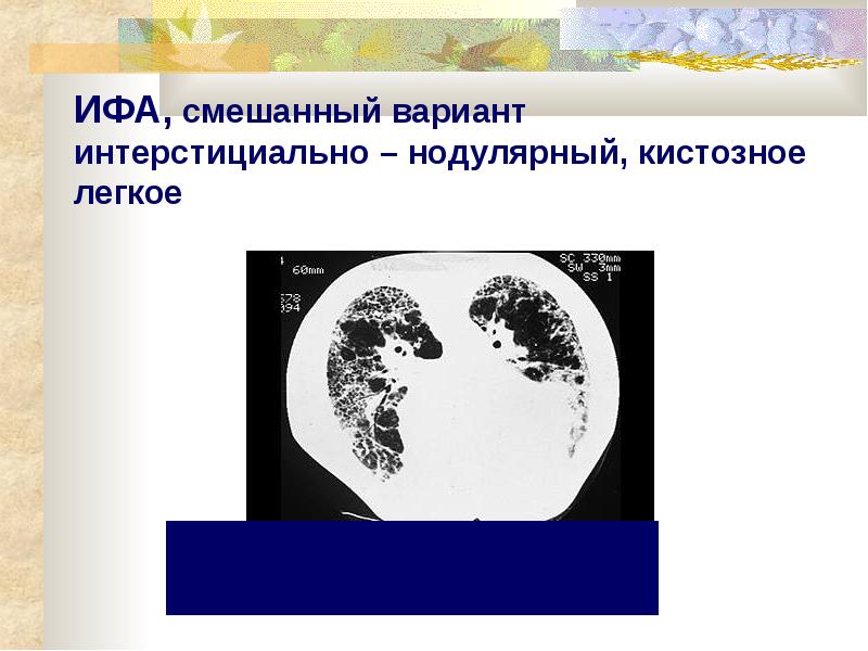 Смешанный вариант. Гломерулонефрит нефротический синдром. Смешанный вариант. Смешанный вариант. Раздражительность и слабость.