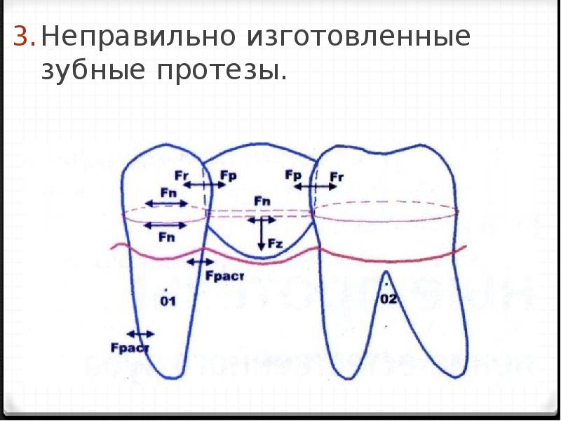 Изготовлены неправильно. Биомеханика мостовидных протезов. Неправильно изготовленные протезы. Мостовидный протез схема. Биомеханика в ортодонтии.