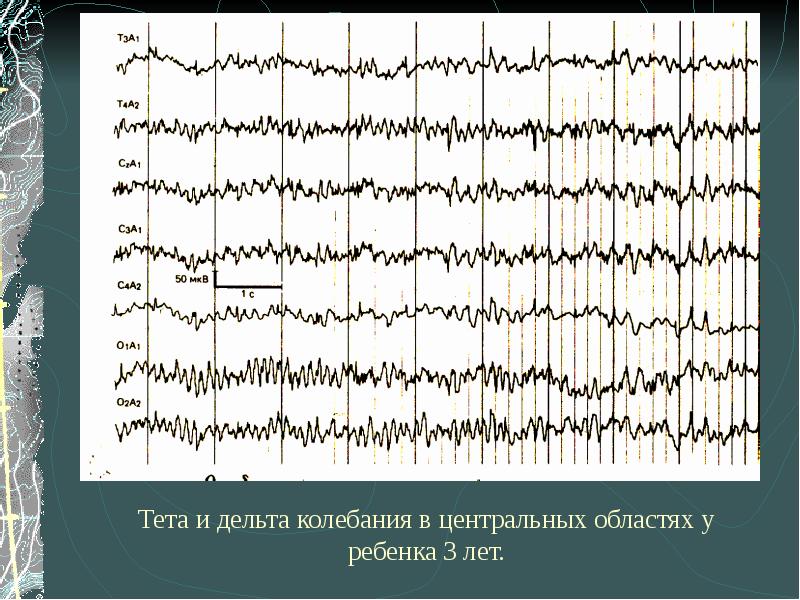 Дельта щетки на ЭЭГ. Ритмы ЭЭГ. Дельта активность на ЭЭГ У детей. Дельта ритм ЭЭГ.