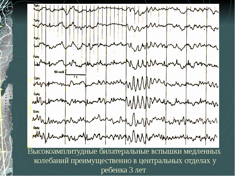 Билатерально синхронная вспышка