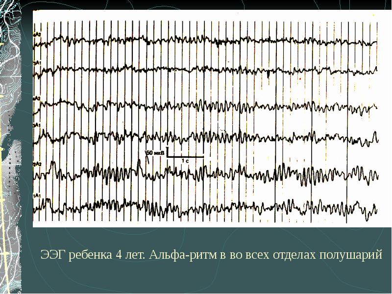 Альфа ритм. Альфа ритм ЭЭГ. ЭЭГ 6 лет бета ритм. Бета ритм ЭЭГ И Альфа ритм. Параметры Альфа ритма на ЭЭГ.